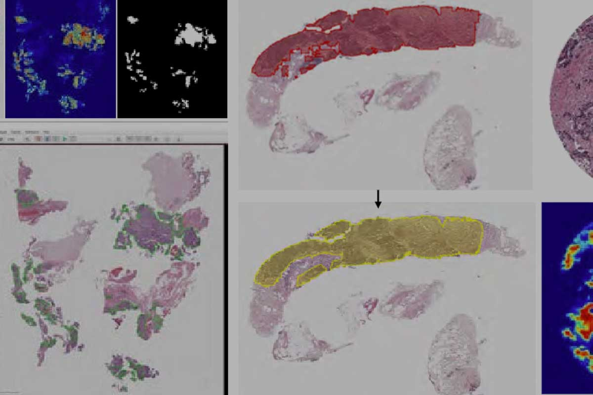 Deep learning–based histologic classifiers enable molecular subtyping of metastatic prostate cancer
